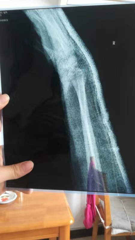 安陽沃爾瑪顧客摔成骨折商場推委扯皮